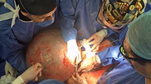 视频显示，世界上最大的囊肿被切除，拯救了一名女子的生命