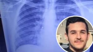 令人震惊的X射线显示青少年的肺部充满了'来自Vaping的凝固油'