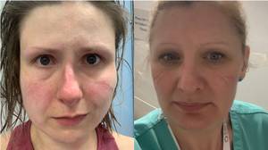 NHS员工分享瘀伤面孔的照片，鼓励社交偏移
