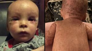 大麻油治疗幼儿，由于皮肤状况，幼儿看起来像鱼子'