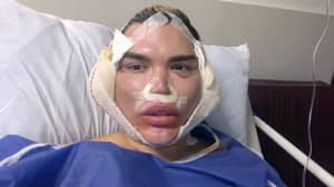 “人类肯娃娃”罗德里戈·阿尔维斯（Rodrigo Alves）警告人们关于修订手术后的面部手术