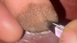 女人揭示皮肤移植留下了她的阴毛从她的手指上生长