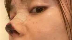手术后的女人留下黑色腐烂的鼻子出错