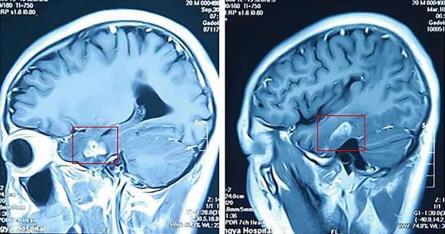 医生从该患者的大脑中取出了四英寸长的寄生虫。信用：Asiawire