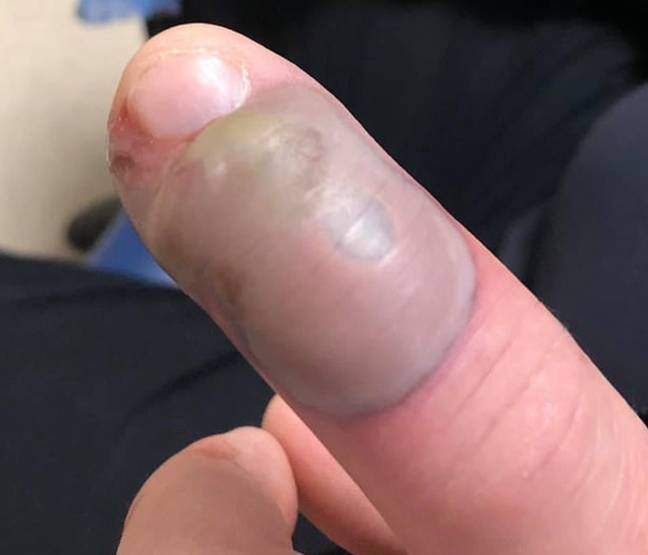 您可以采取一些措施来帮助您减少指甲咬伤。信用：Facebook