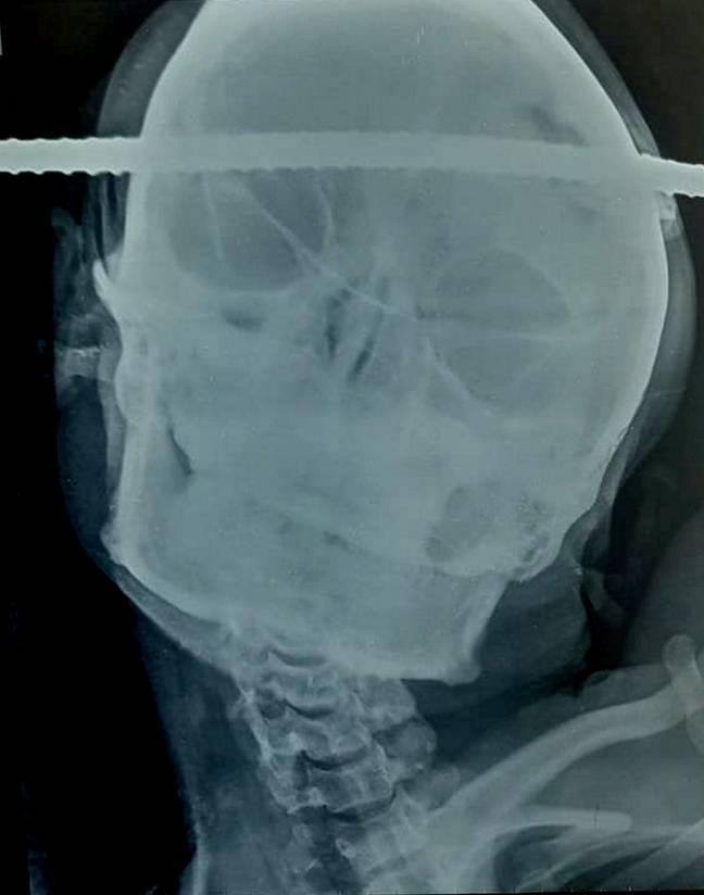 X射线显示杆直接穿过他的头部。信贷：SWNS