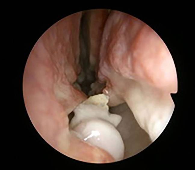 这是牙齿的内窥镜拍摄的照片，然后将其除去。信用：BMJ案例报告