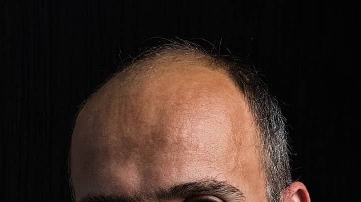 新的干细胞溶液触发男性秃发的人的头发再生