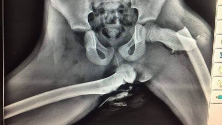 可怕的X射线图像显示了用脚在仪表板上坠毁后的女人的臀部