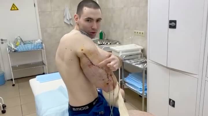“俄罗斯的Popeye”接受手术，以从假肌肉中去除硬化的果冻