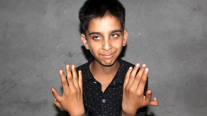 十二岁的男孩双手额外的拇指