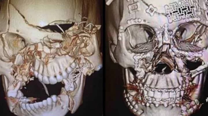 医生在事故发生后炫耀令人难以置信的面部重建