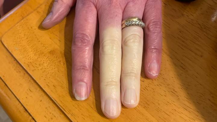 妈妈的手指完全变成白色，这得益于罕见的疾病